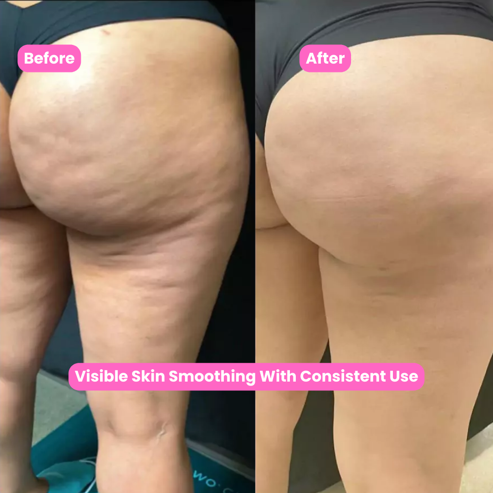 3 in 1 Cellulite massager